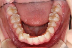 右下側切歯が舌側転位しています